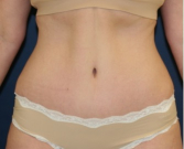 Feel Beautiful - Fitness Tummy Tuck 144 - After Photo